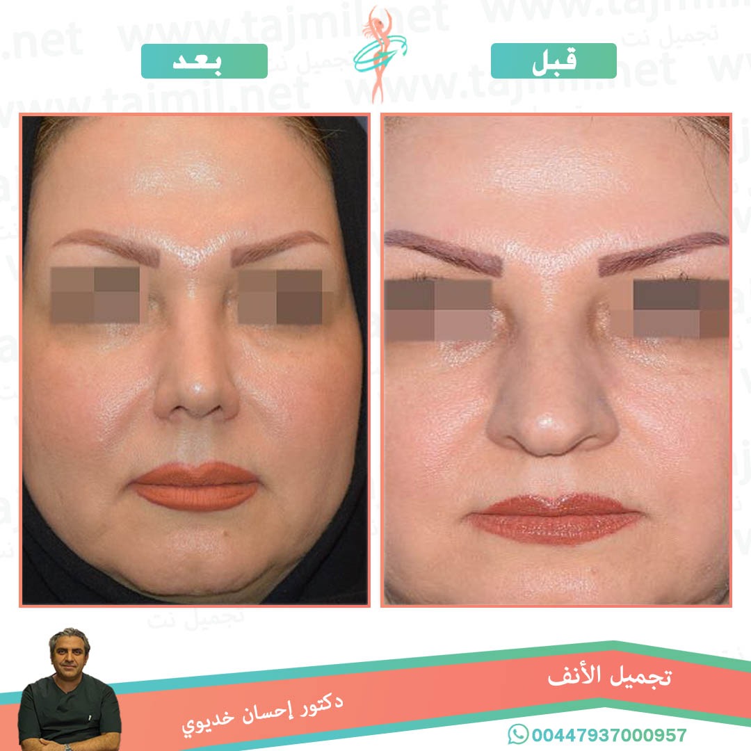  - دکتور إحسان خدیوي عملية تجميل الانف في ايران مع تجميل نت