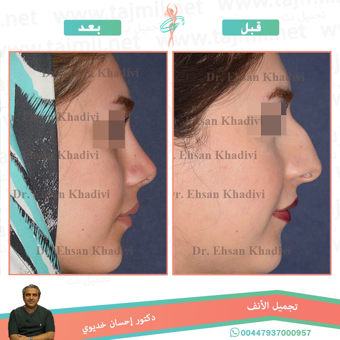  - دکتور إحسان خدیوي عملية تجميل الانف في ايران مع تجميل نت