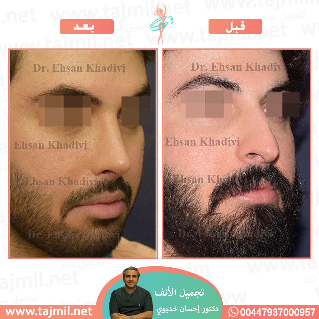  - دکتور إحسان خدیوي عملية تجميل الانف في ايران مع تجميل نت