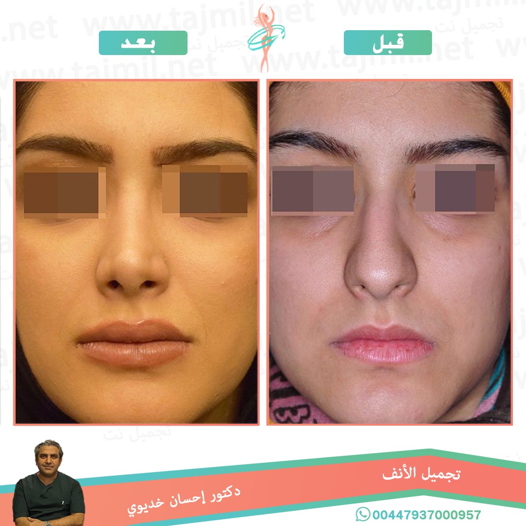  - دکتور إحسان خدیوي عملية تجميل الانف في ايران مع تجميل نت