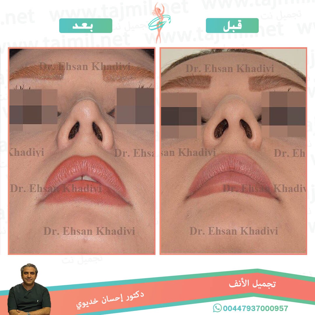  - دکتور إحسان خدیوي عملية تجميل الانف في ايران مع تجميل نت