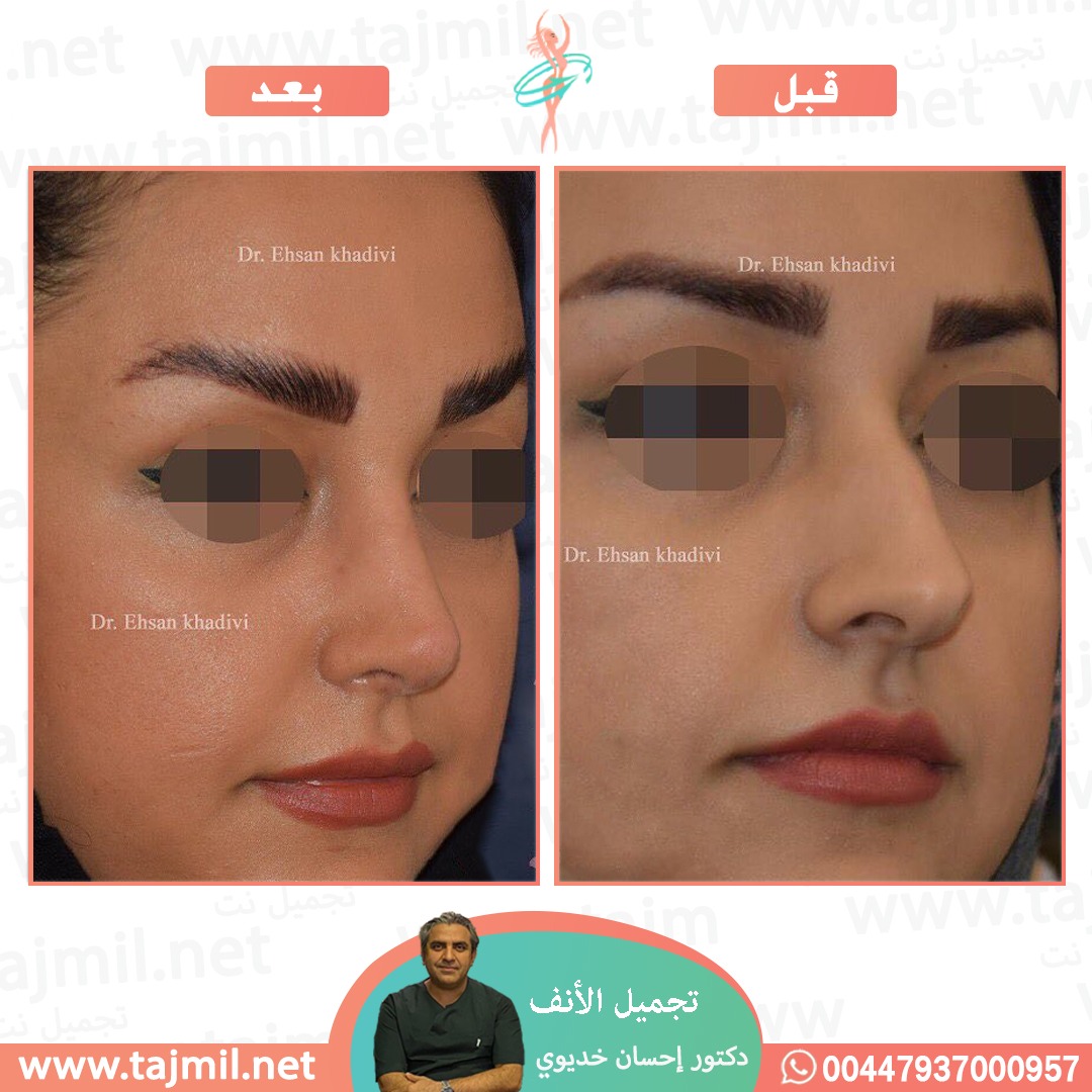  - دکتور إحسان خدیوي عملية تجميل الانف في ايران مع تجميل نت