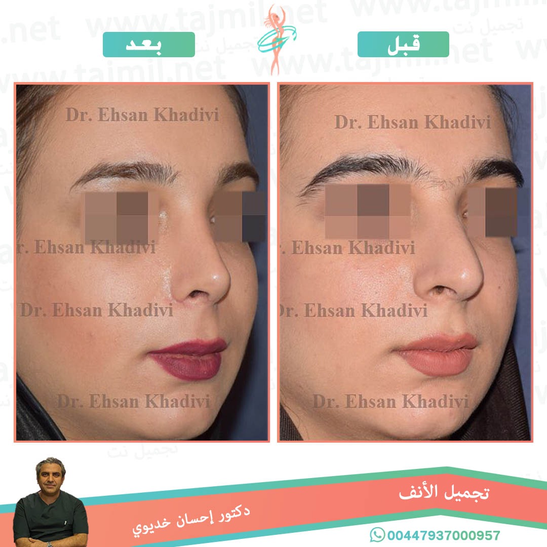  - دکتور إحسان خدیوي عملية تجميل الانف في ايران مع تجميل نت