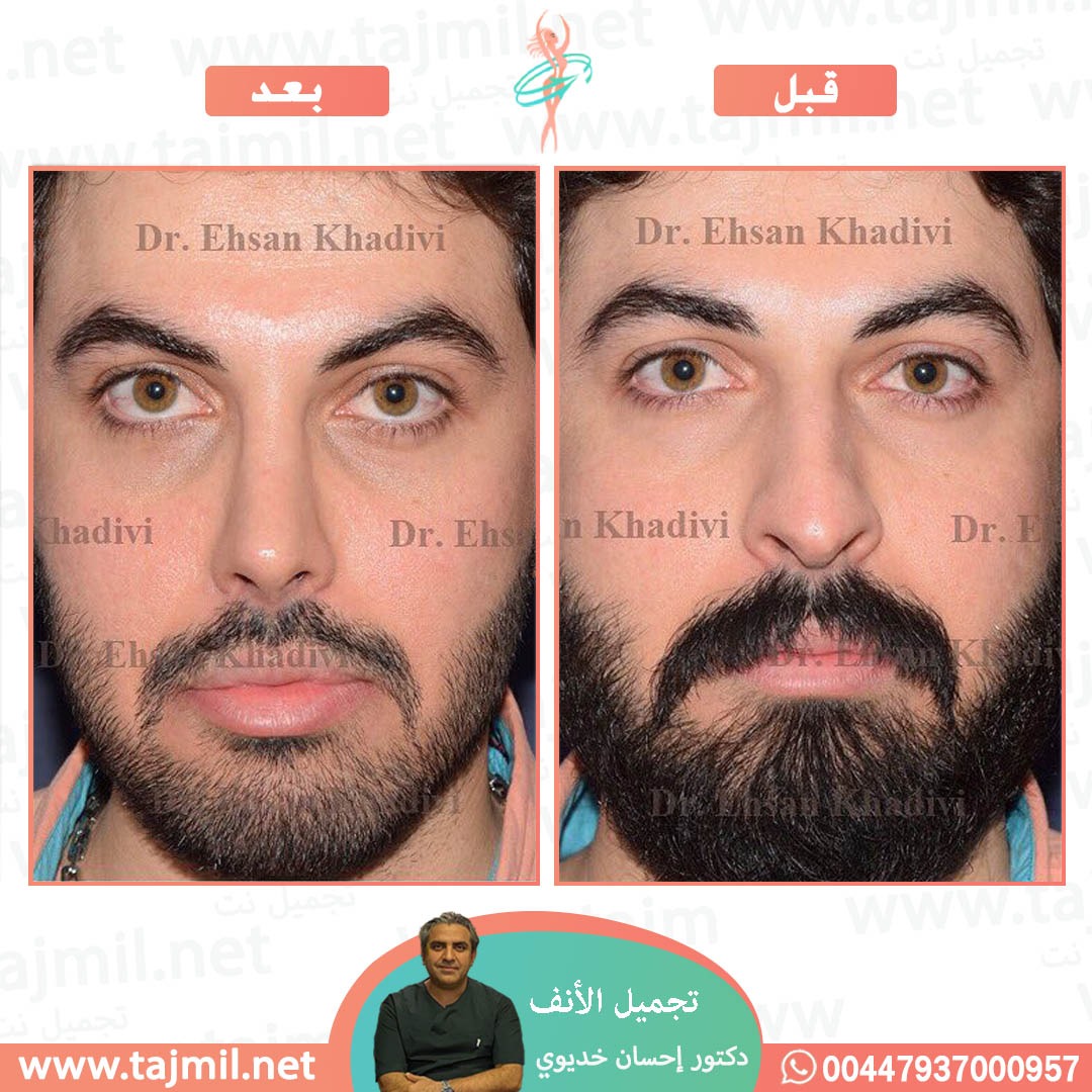  - دکتور إحسان خدیوي عملية تجميل الانف في ايران مع تجميل نت