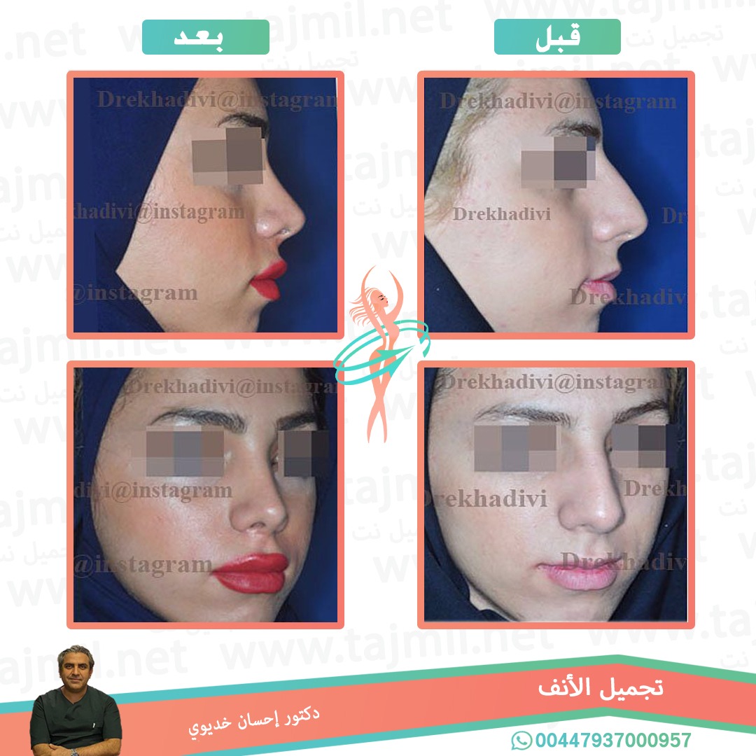  - دکتور إحسان خدیوي عملية تجميل الانف في ايران مع تجميل نت