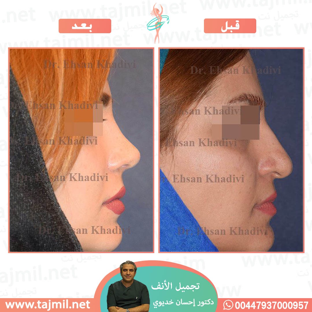  - دکتور إحسان خدیوي عملية تجميل الانف في ايران مع تجميل نت