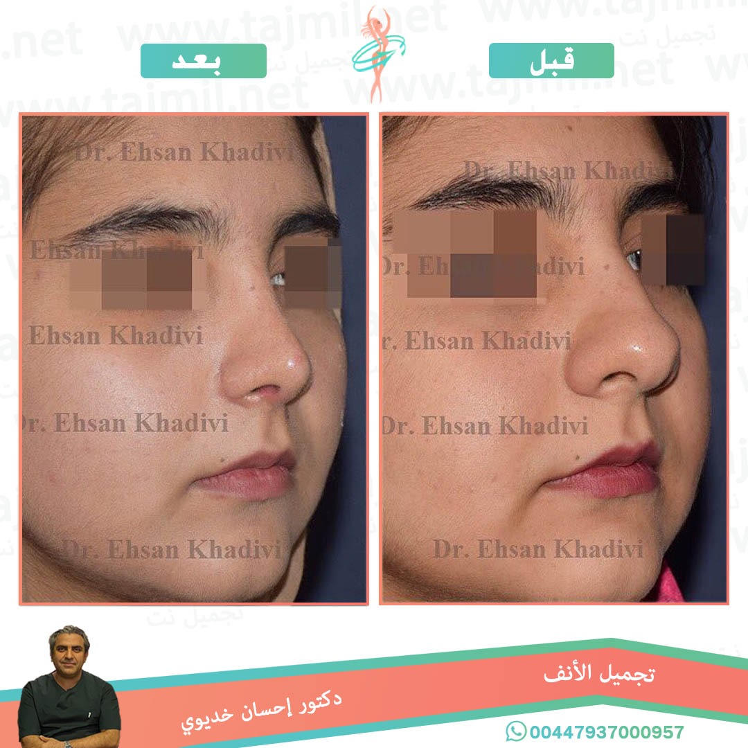  - دکتور إحسان خدیوي عملية تجميل الانف في ايران مع تجميل نت