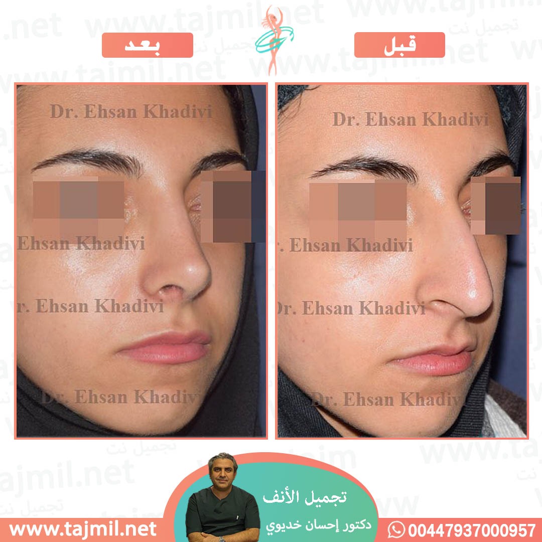  - دکتور إحسان خدیوي عملية تجميل الانف في ايران مع تجميل نت