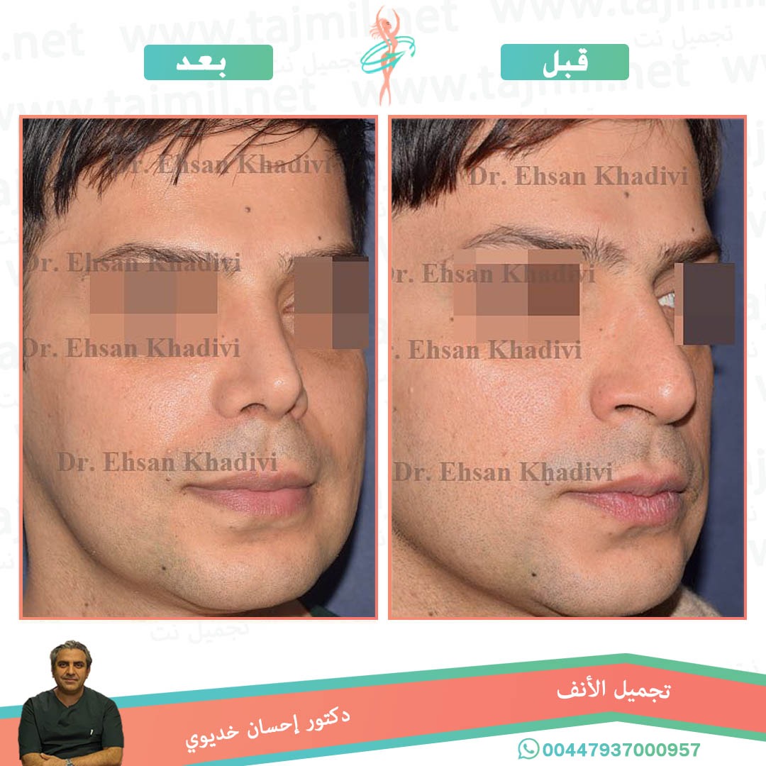  - دکتور إحسان خدیوي عملية تجميل الانف في ايران مع تجميل نت