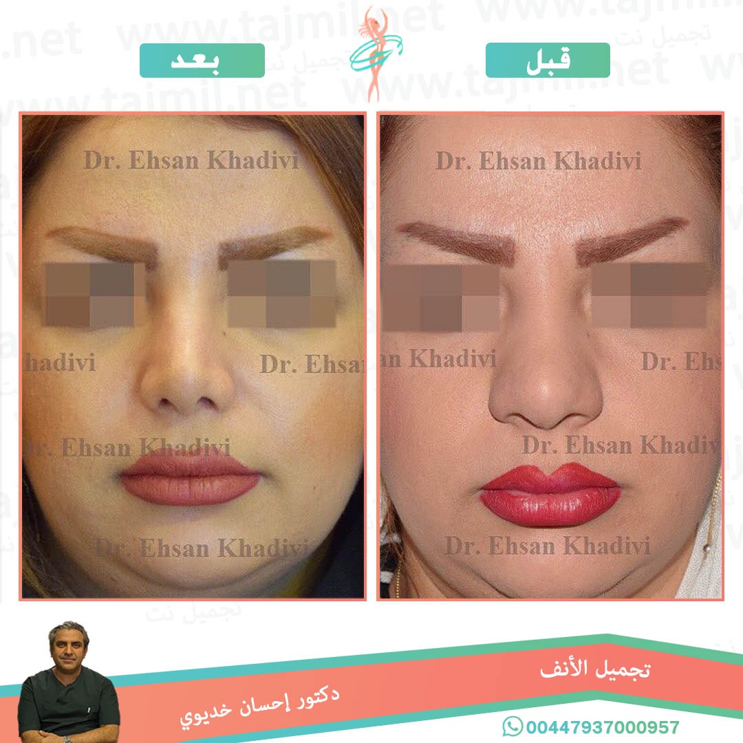  - دکتور إحسان خدیوي عملية تجميل الانف في ايران مع تجميل نت