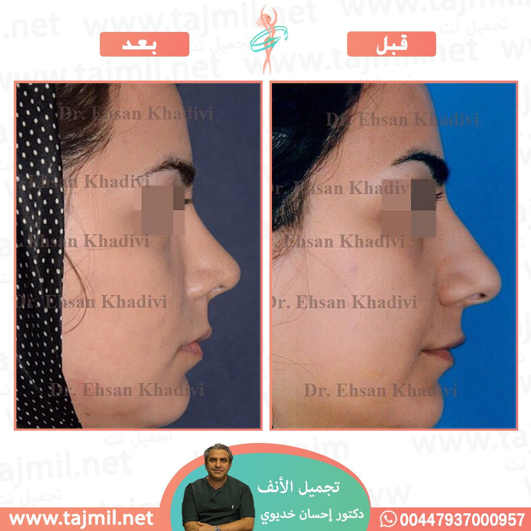  - دکتور إحسان خدیوي عملية تجميل الانف في ايران مع تجميل نت