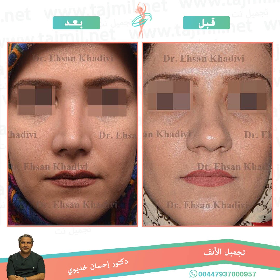  - دکتور إحسان خدیوي عملية تجميل الانف في ايران مع تجميل نت