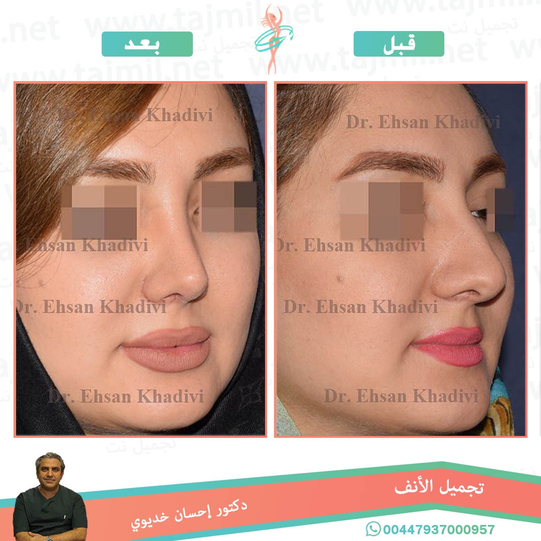  - دکتور إحسان خدیوي عملية تجميل الانف في ايران مع تجميل نت