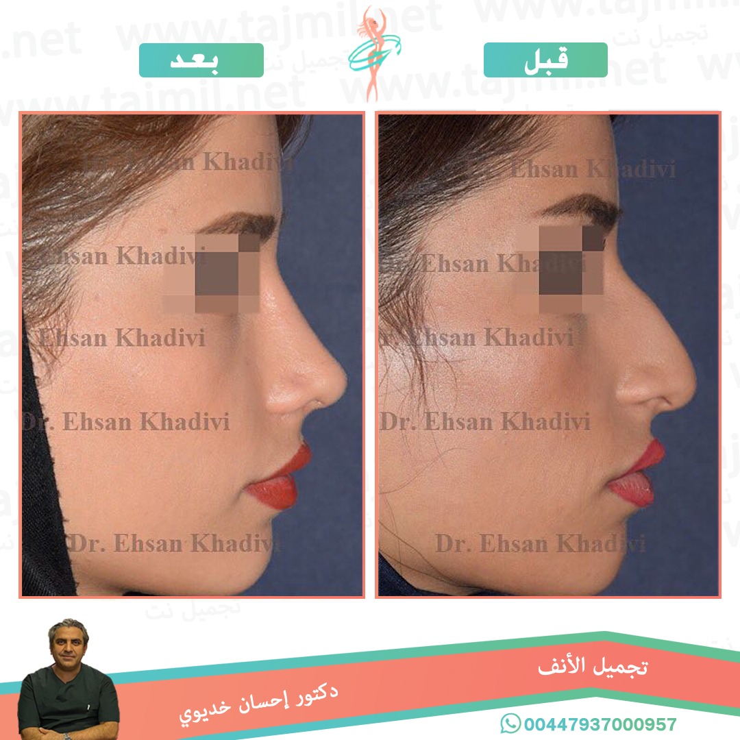  - دکتور إحسان خدیوي عملية تجميل الانف في ايران مع تجميل نت