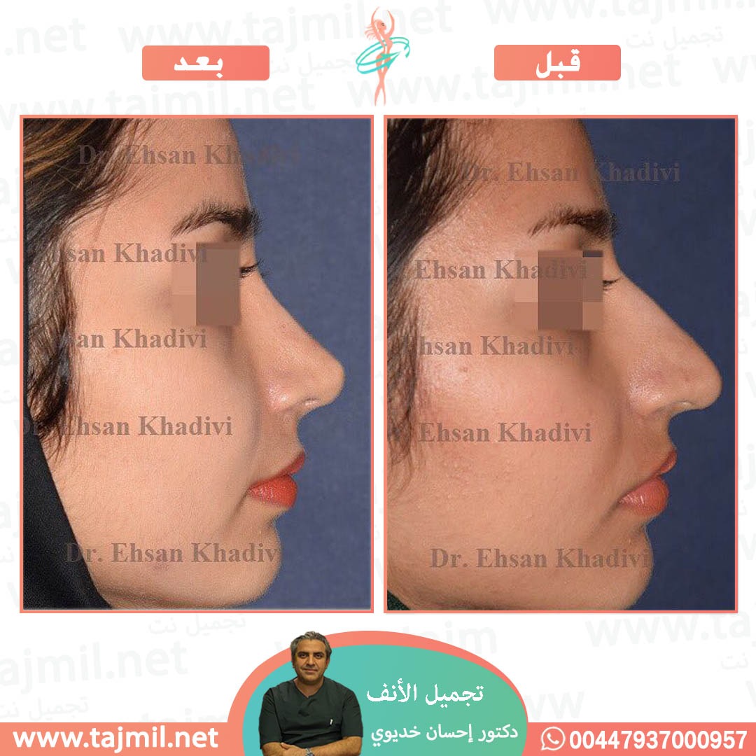  - دکتور إحسان خدیوي عملية تجميل الانف في ايران مع تجميل نت