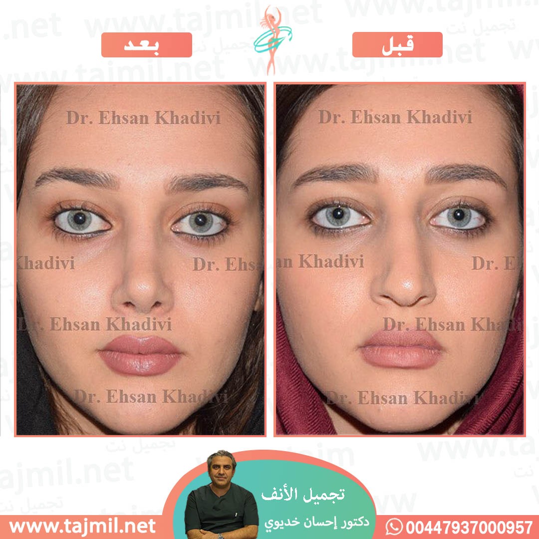  - دکتور إحسان خدیوي عملية تجميل الانف في ايران مع تجميل نت