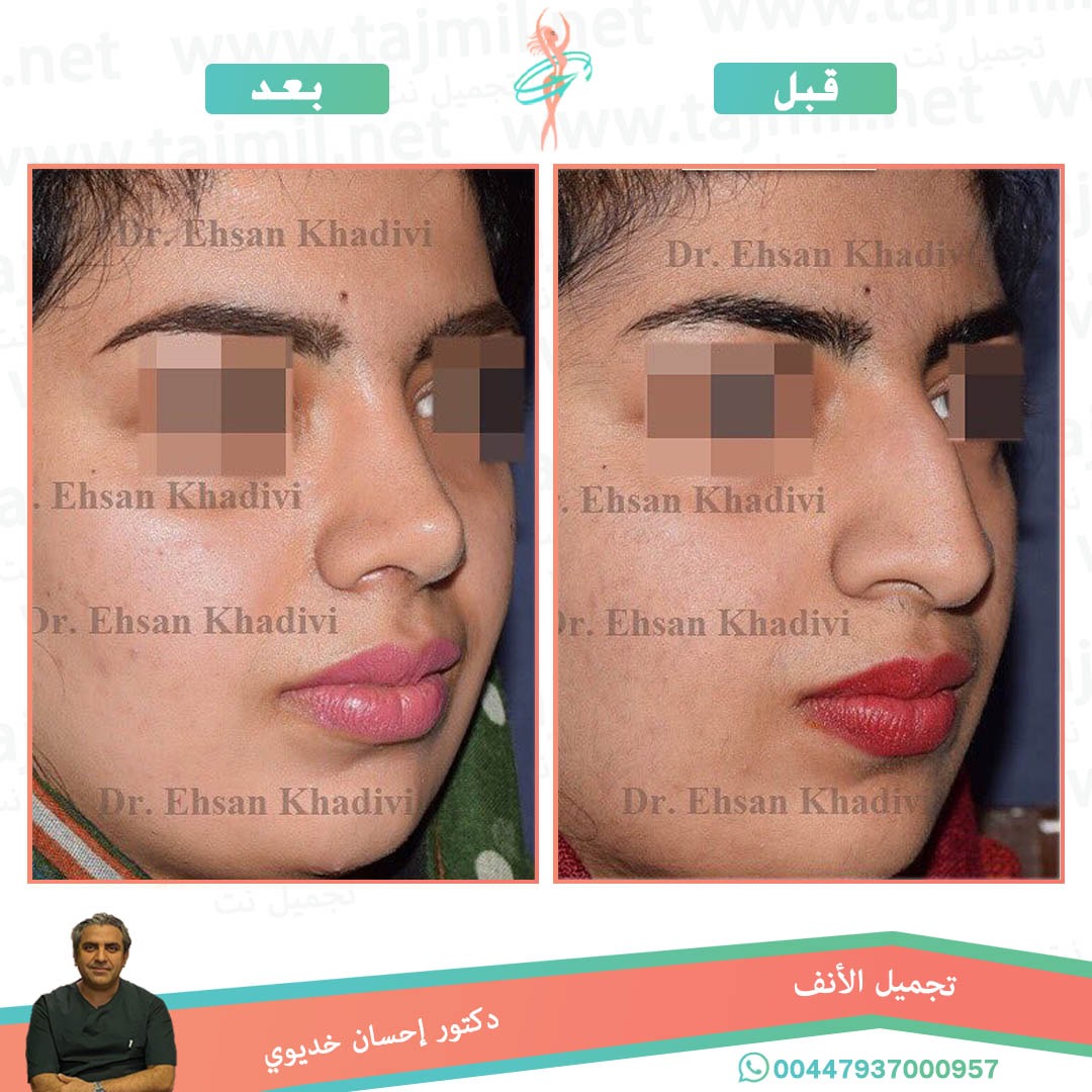  - دکتور إحسان خدیوي عملية تجميل الانف في ايران مع تجميل نت