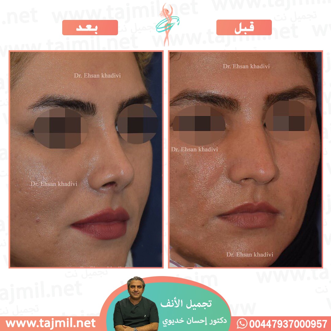  - دکتور إحسان خدیوي عملية تجميل الانف في ايران مع تجميل نت