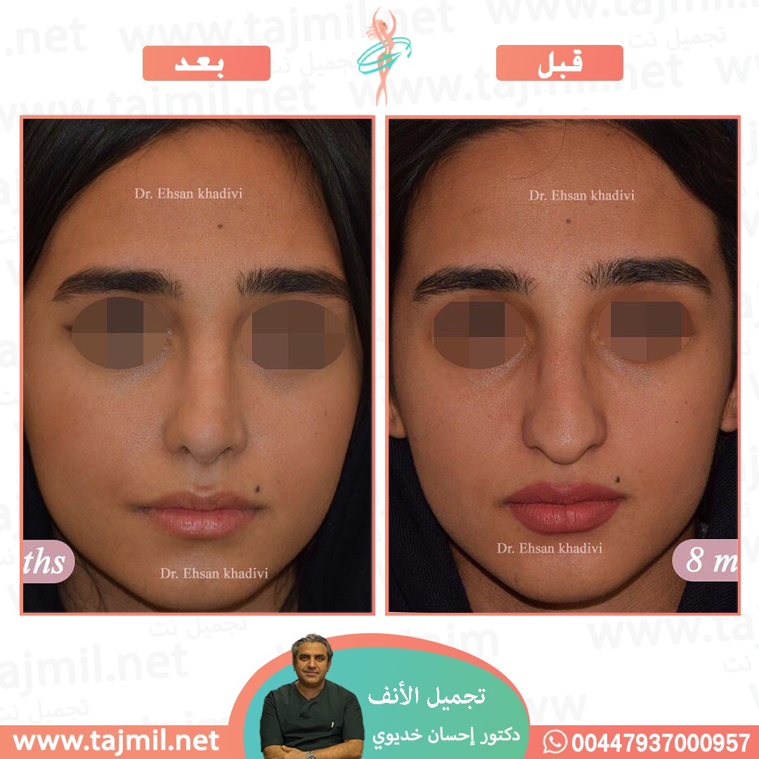  - دکتور إحسان خدیوي عملية تجميل الانف في ايران مع تجميل نت