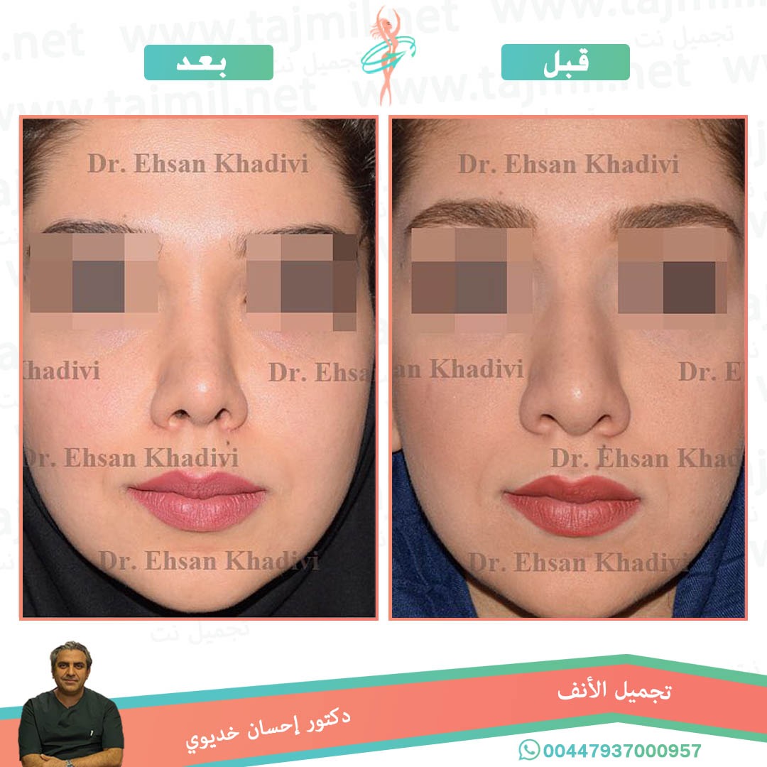  - دکتور إحسان خدیوي عملية تجميل الانف في ايران مع تجميل نتدکتور إحسان خدیوي عملية تجميل الانف في ايران مع تجميل نت