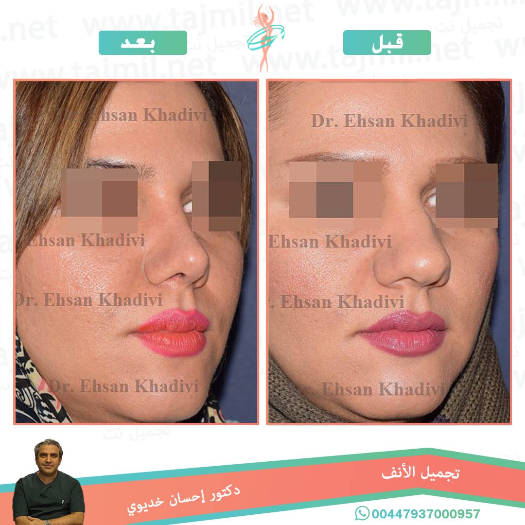  - دکتور إحسان خدیوي عملية تجميل الانف في ايران مع تجميل نت