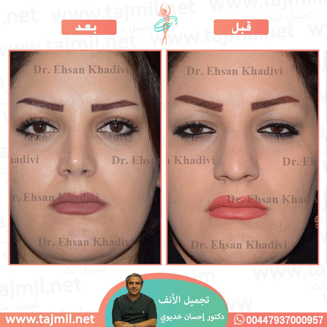  - دکتور إحسان خدیوي عملية تجميل الانف في ايران مع تجميل نت