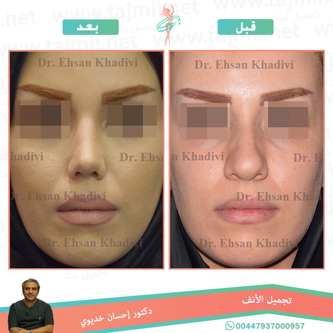  - دکتور إحسان خدیوي عملية تجميل الانف في ايران مع تجميل نت