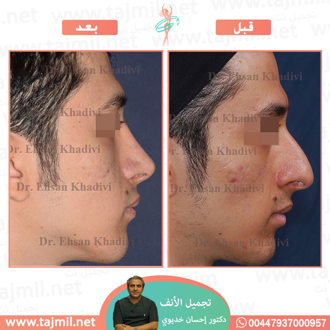  - دکتور إحسان خدیوي عملية تجميل الانف في ايران مع تجميل نت