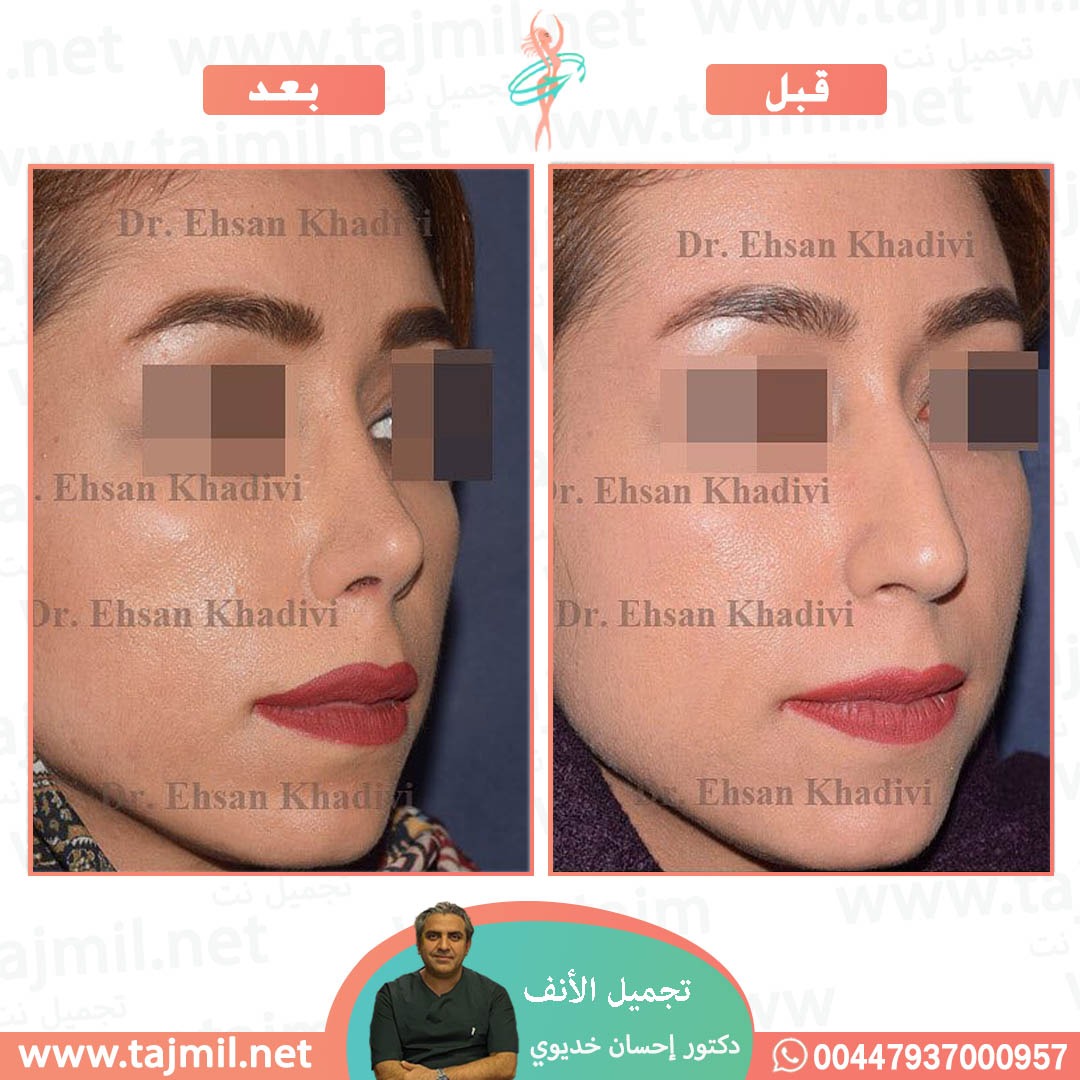  - دکتور إحسان خدیوي عملية تجميل الانف في ايران مع تجميل نت