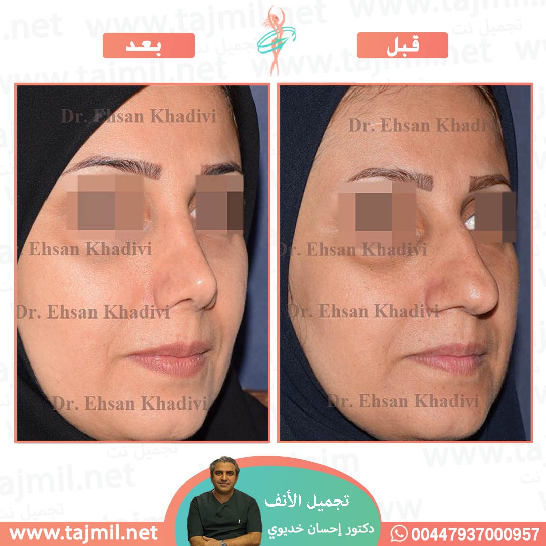  - دکتور إحسان خدیوي عملية تجميل الانف في ايران مع تجميل نت