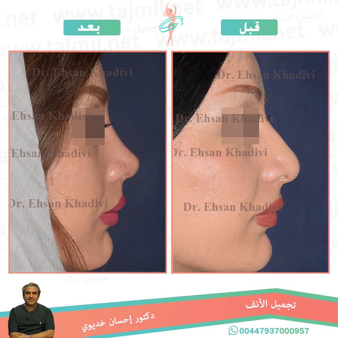  - دکتور إحسان خدیوي عملية تجميل الانف في ايران مع تجميل نت