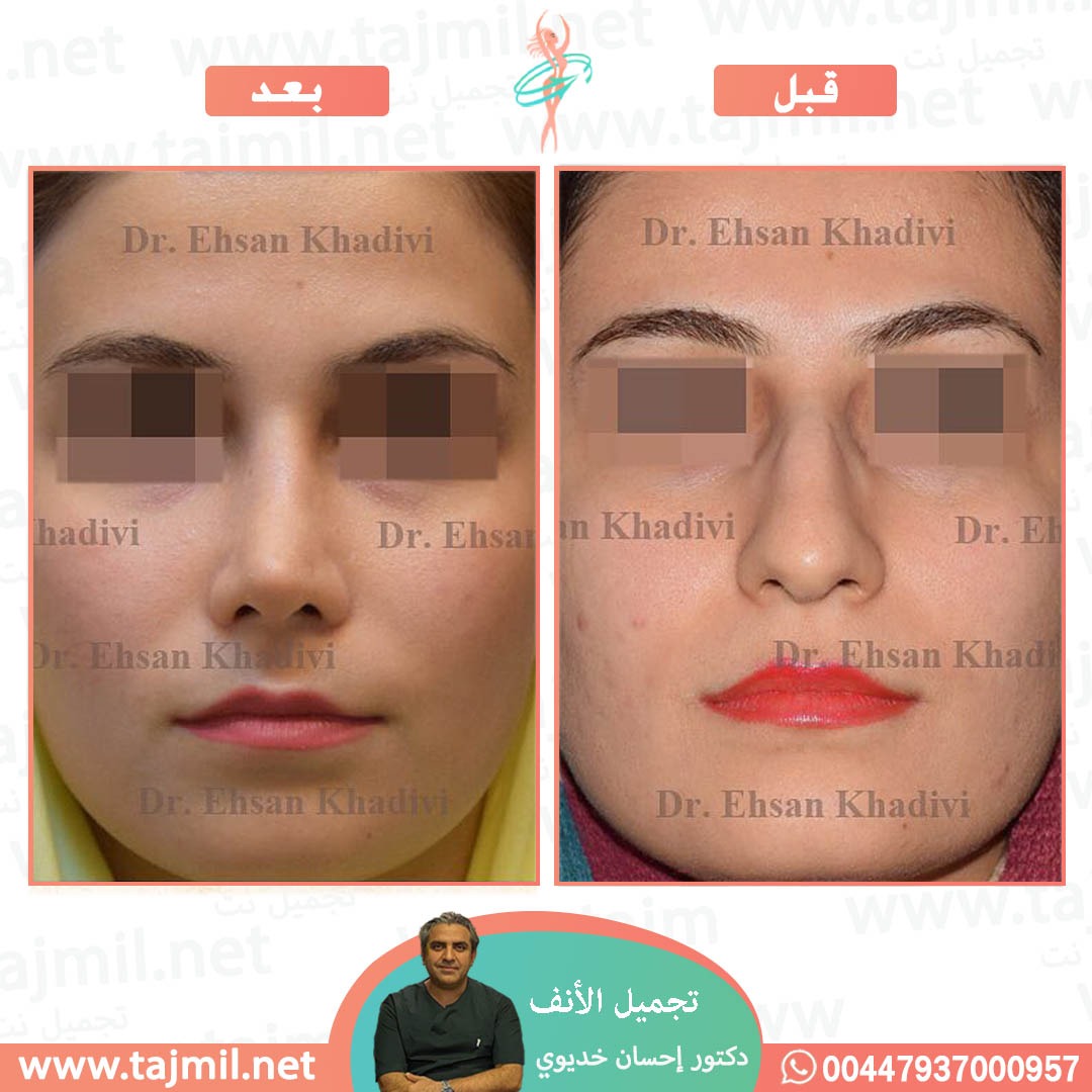  - دکتور إحسان خدیوي عملية تجميل الانف في ايران مع تجميل نت