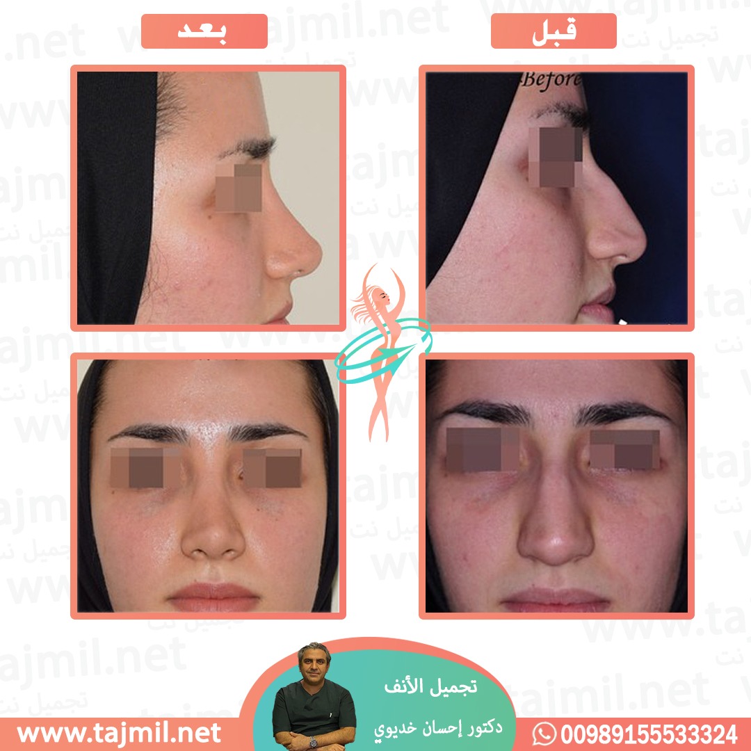  - دکتور إحسان خدیوي عملية تجميل الانف في ايران مع تجميل نت