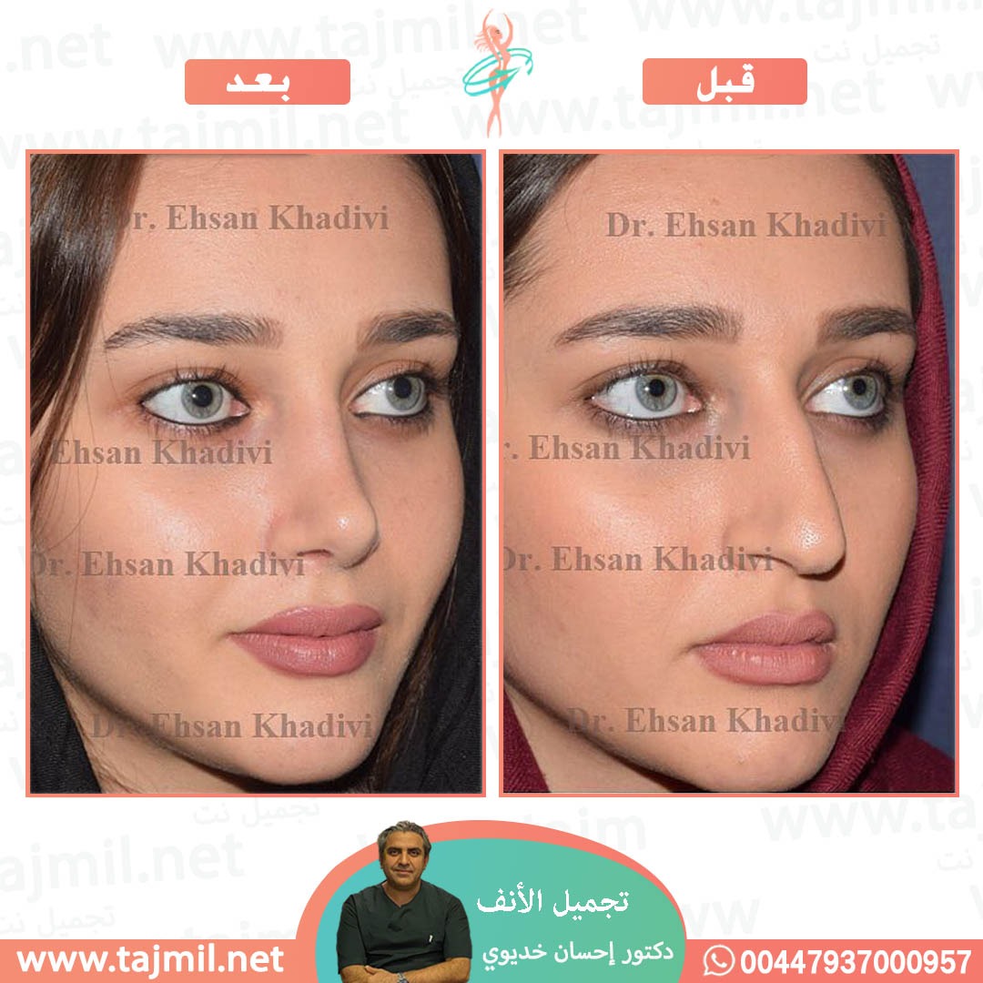  - دکتور إحسان خدیوي عملية تجميل الانف في ايران مع تجميل نت