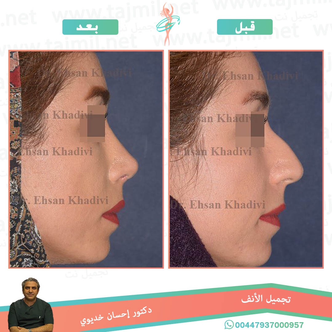  - دکتور إحسان خدیوي عملية تجميل الانف في ايران مع تجميل نت