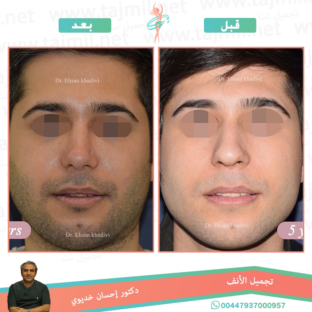  - دکتور إحسان خدیوي عملية تجميل الانف في ايران مع تجميل نت