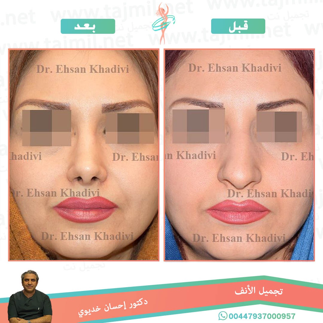  - دکتور إحسان خدیوي عملية تجميل الانف في ايران مع تجميل نت