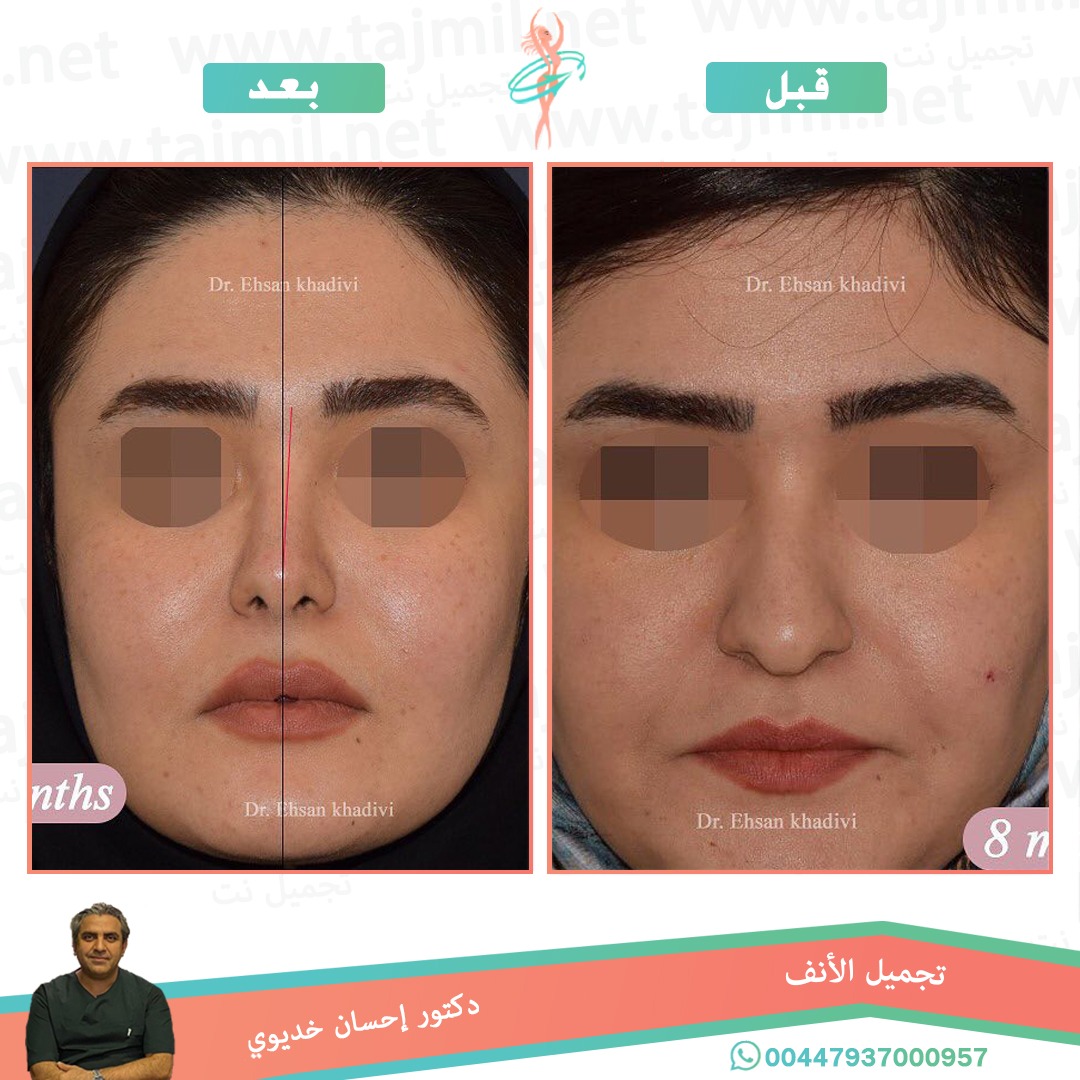  - دکتور إحسان خدیوي عملية تجميل الانف في ايران مع تجميل نت