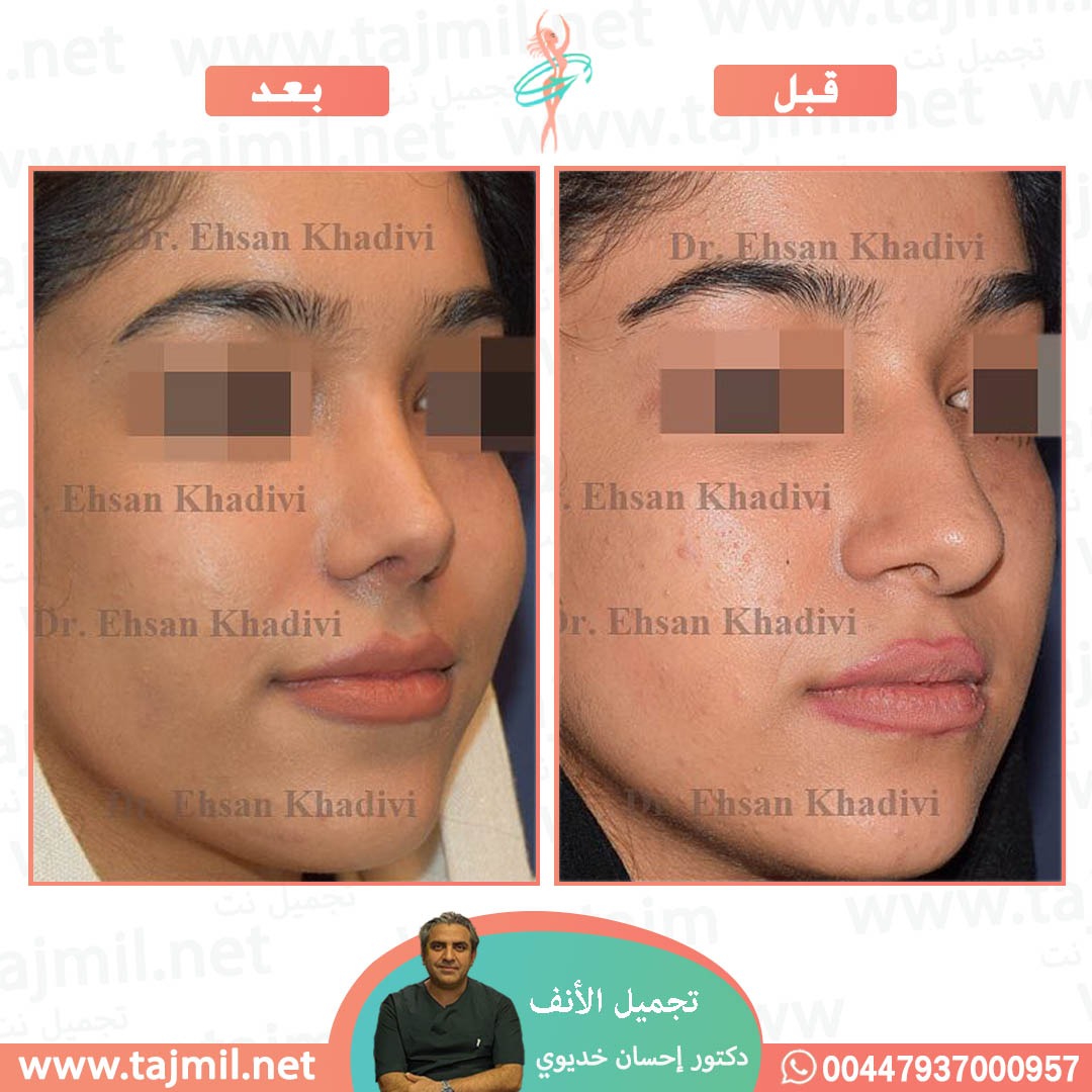  - دکتور إحسان خدیوي عملية تجميل الانف في ايران مع تجميل نت