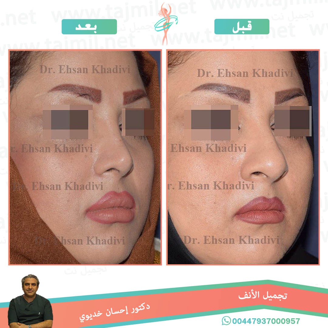  - دکتور إحسان خدیوي عملية تجميل الانف في ايران مع تجميل نتدکتور إحسان خدیوي عملية تجميل الانف في ايران مع تجميل نت