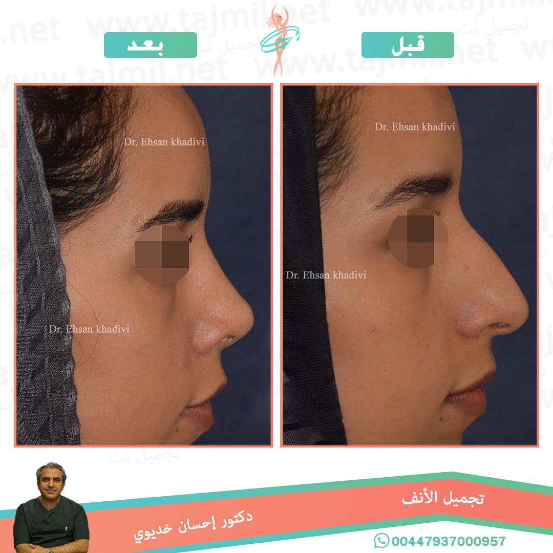  - دکتور إحسان خدیوي عملية تجميل الانف في ايران مع تجميل نت