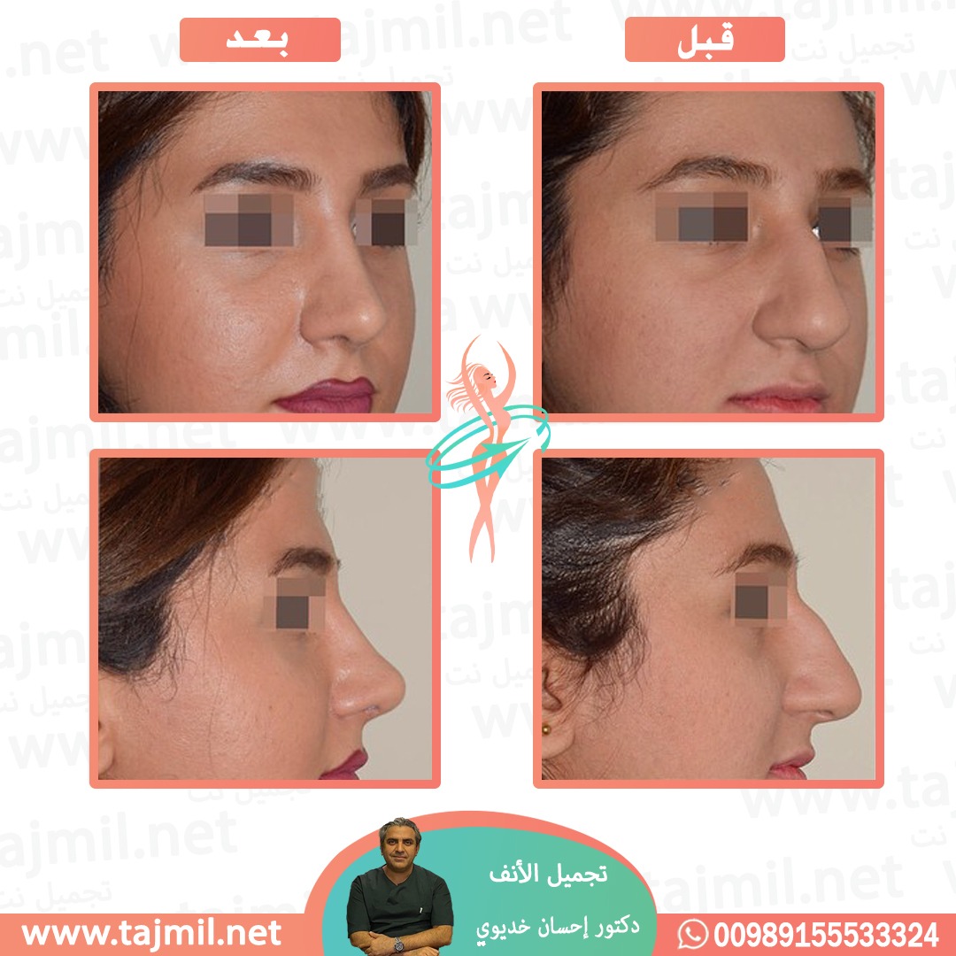  - دکتور إحسان خدیوي عملية تجميل الانف في ايران مع تجميل نت