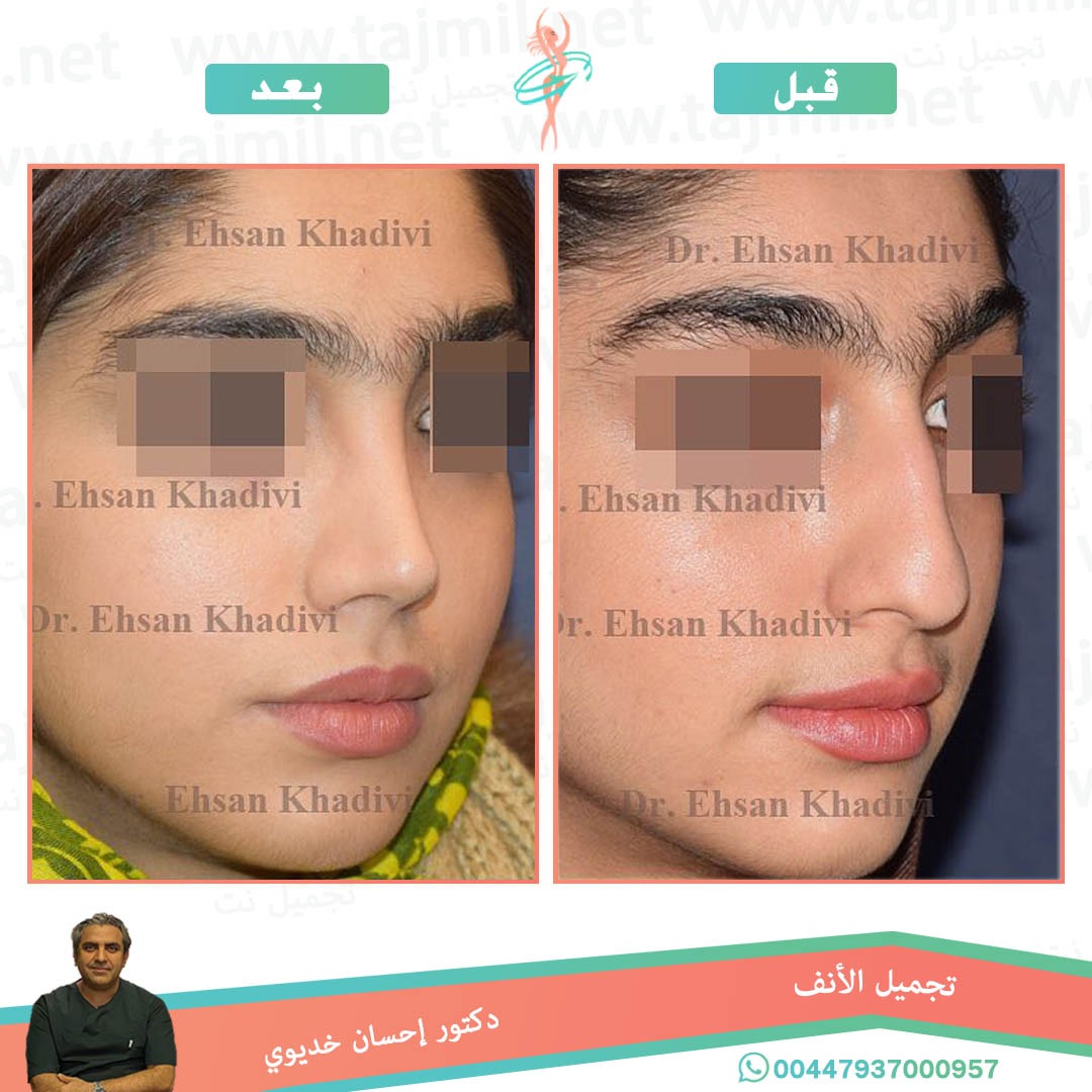  - دکتور إحسان خدیوي عملية تجميل الانف في ايران مع تجميل نت