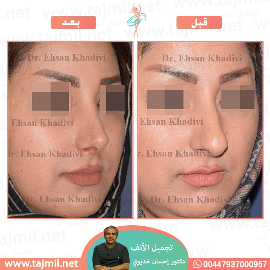  - دکتور إحسان خدیوي عملية تجميل الانف في ايران مع تجميل نت