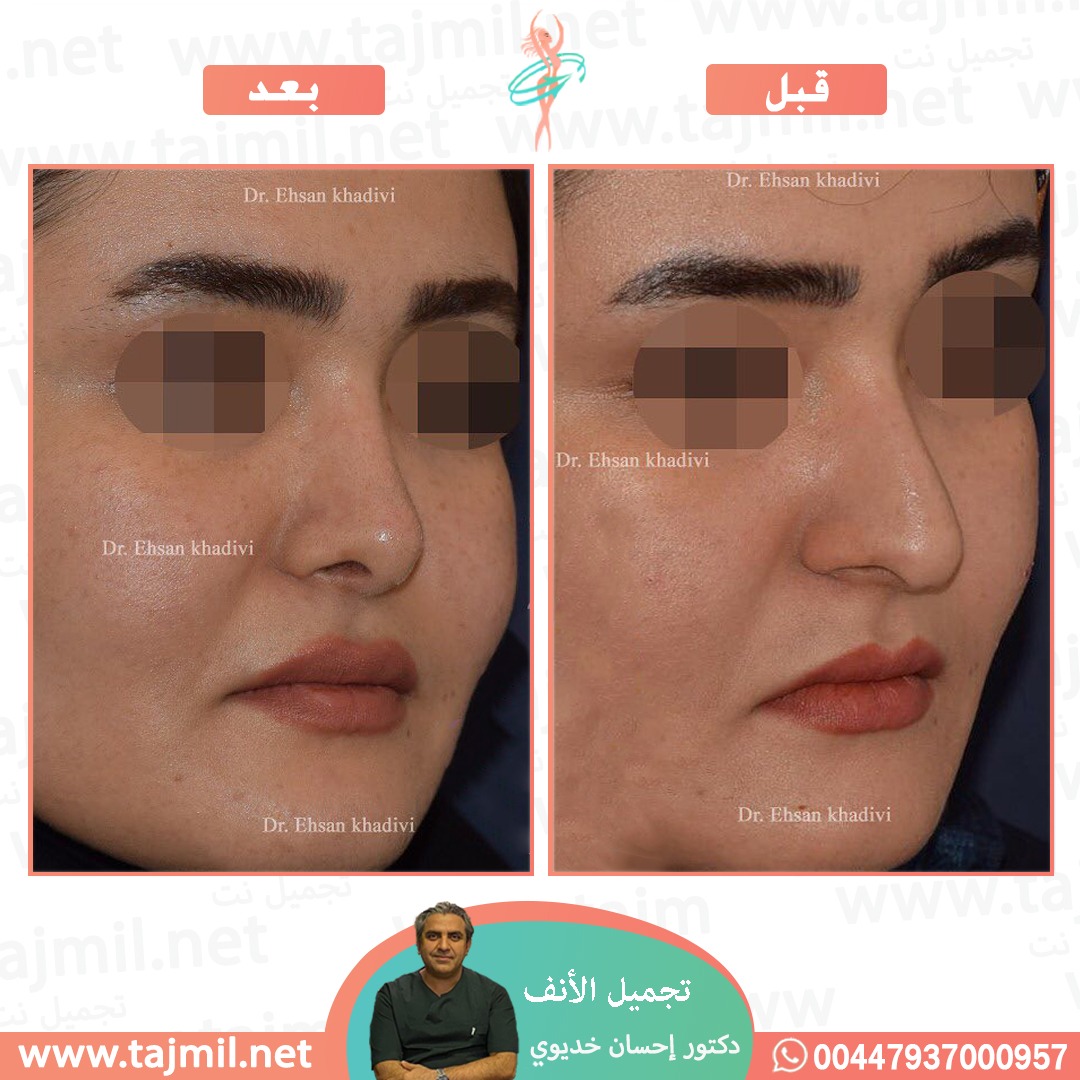  - دکتور إحسان خدیوي عملية تجميل الانف في ايران مع تجميل نت