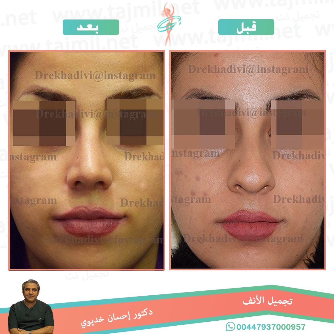  - دکتور إحسان خدیوي عملية تجميل الانف في ايران مع تجميل نت