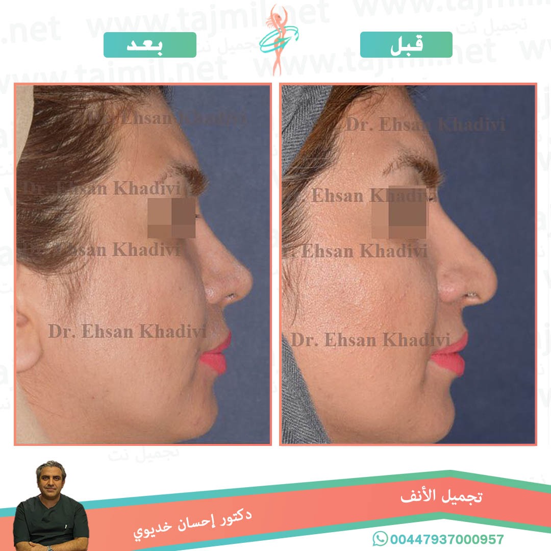  - دکتور إحسان خدیوي عملية تجميل الانف في ايران مع تجميل نت