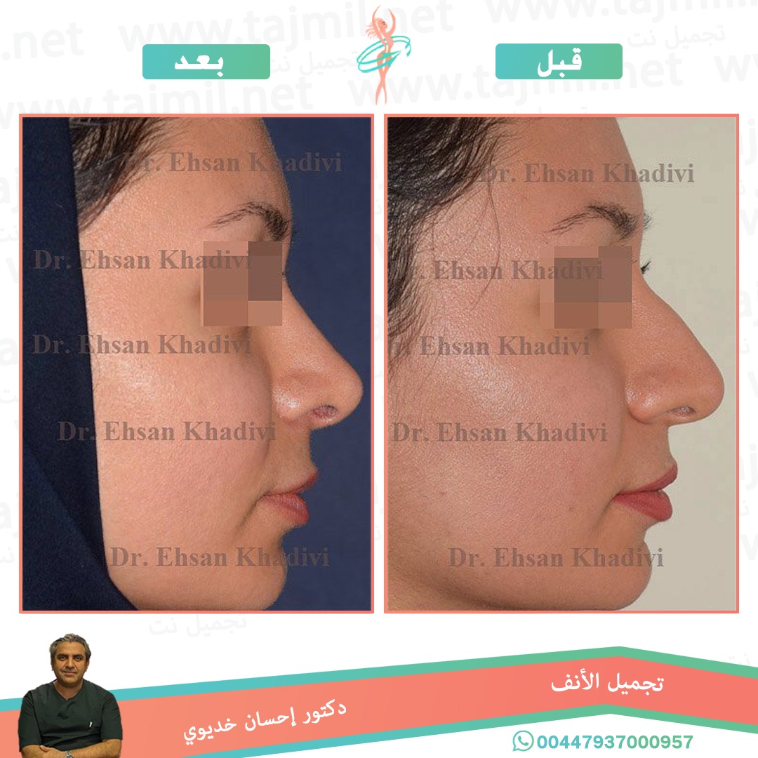  - دکتور إحسان خدیوي عملية تجميل الانف في ايران مع تجميل نت