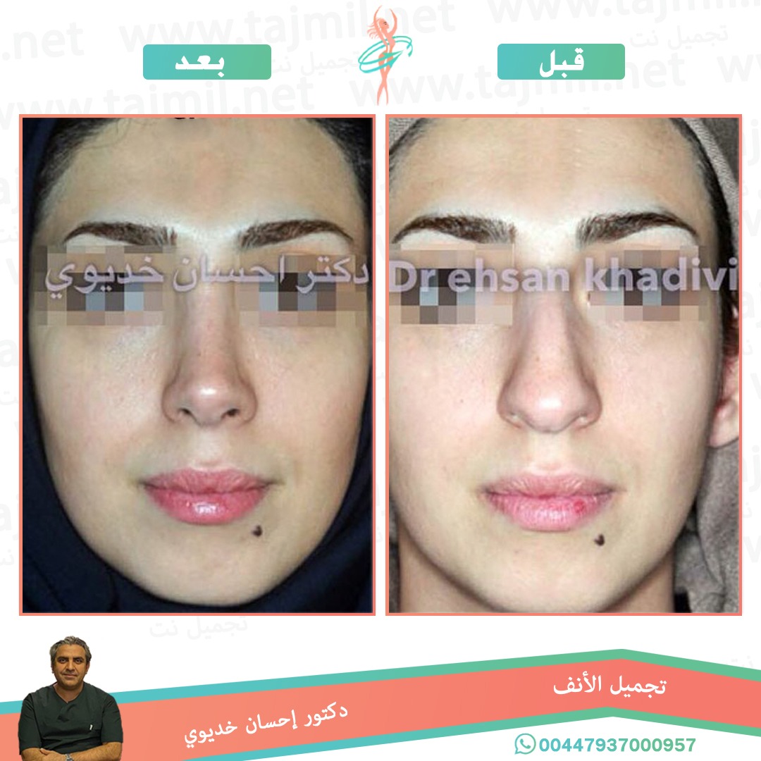  - دکتور إحسان خدیوي عملية تجميل الانف في ايران مع تجميل نت