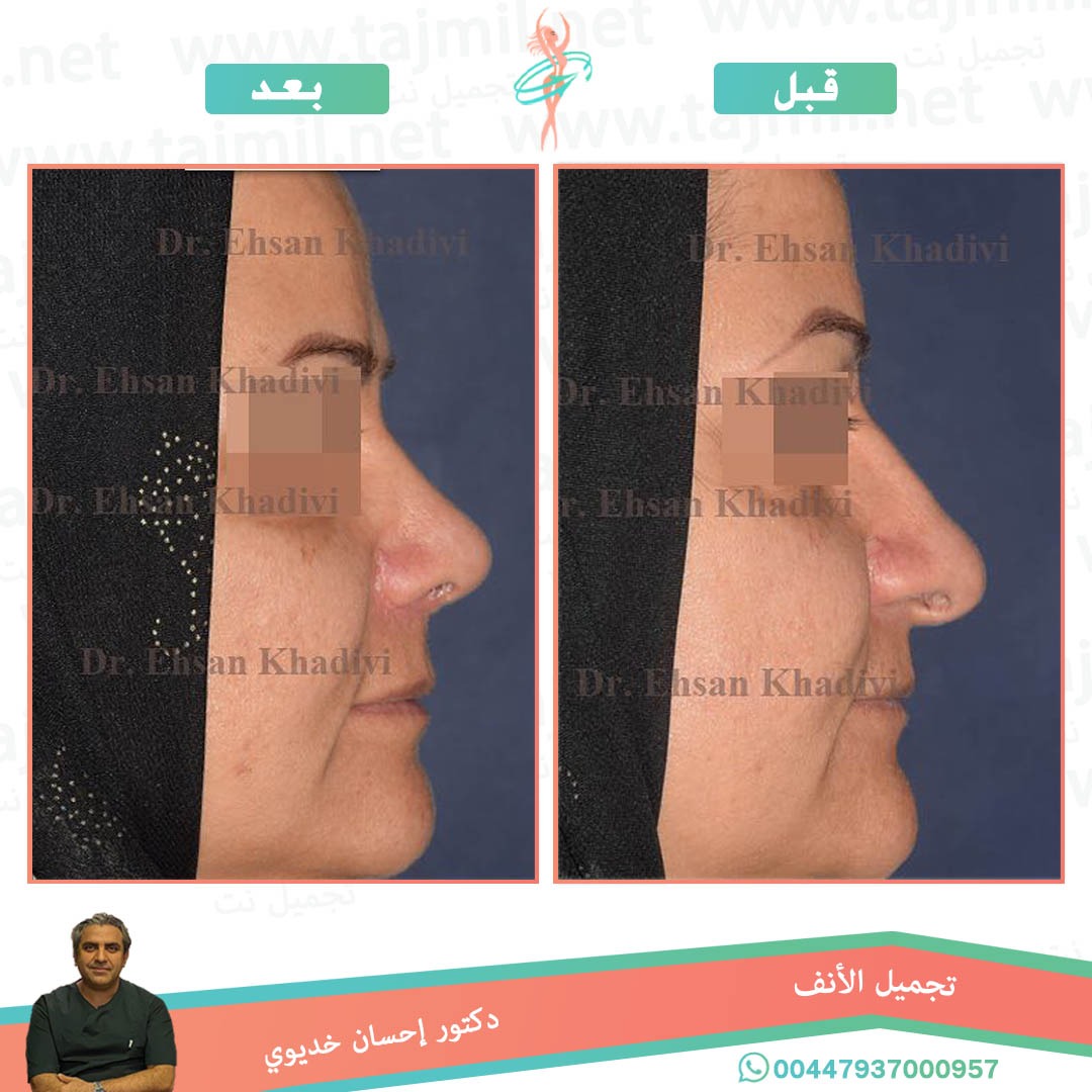  - دکتور إحسان خدیوي عملية تجميل الانف في ايران مع تجميل نت